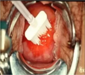 360度來回旋轉一次，同時採集內外頸細胞