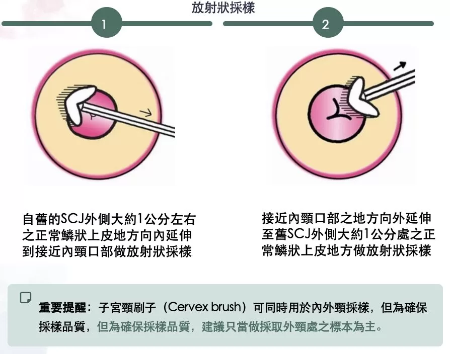 子宮頸刷子(Cervex brush) 採樣