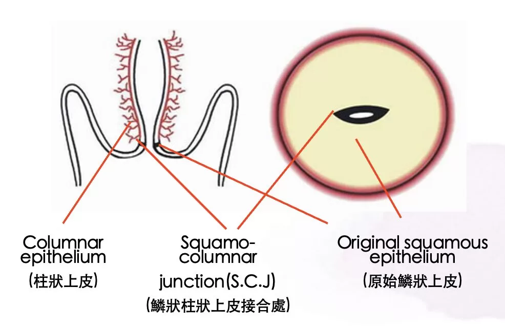 子宮頸癌變高危區域