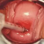 排卵期分泌物處理示意