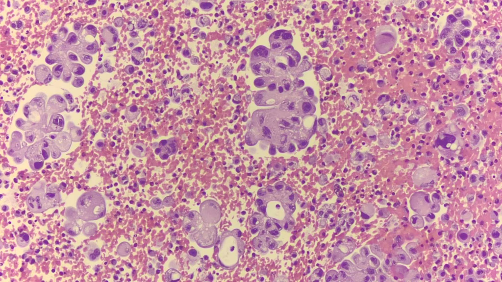 非小細胞肺癌 HE圖 (肋膜積水)