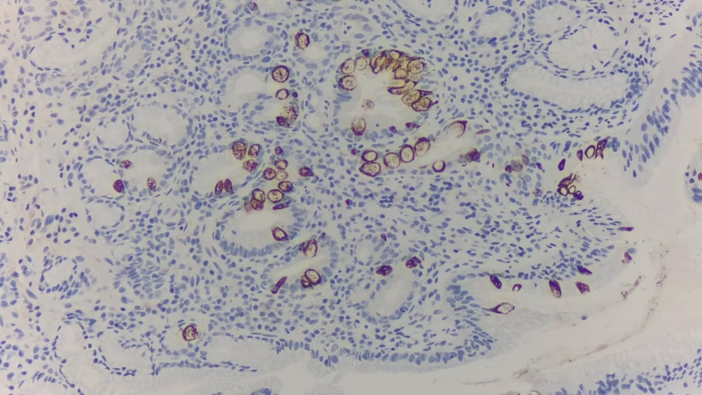 腸化生, MUC2染出杯狀細胞, 免疫染色(immunohistochemical stain)